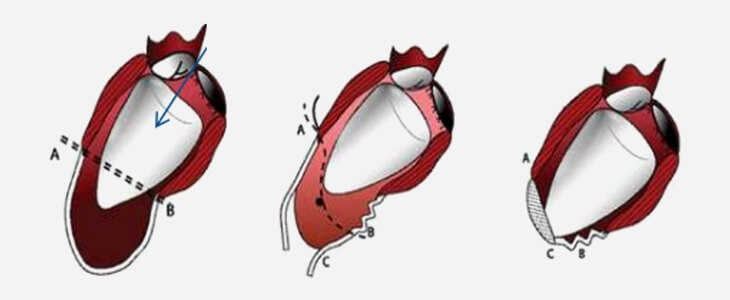 Medical diagram of a heart