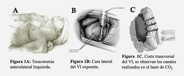 Medical diagram of Transmyocardial Laser Revascularization